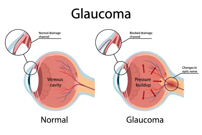 Glaucoma Test Price in Faridabad – What Should You Expect?
